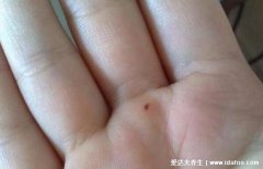 手上朱砂痣真实图片，朱砂痣长在哪里比较
