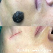 手术切痣后悔死了，容易留下疤痕(正规医院