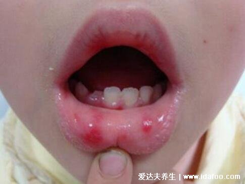 水泡和疱疹的区别图片,疱疹会有身体症状(带状疱疹神经痛)