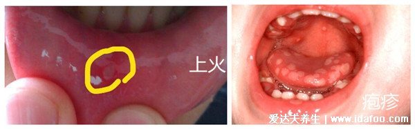 水泡和疱疹的区别图片,疱疹会有身体症状(带状疱疹神经痛)