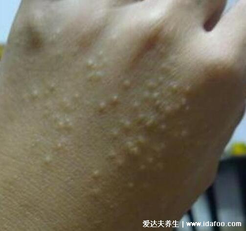 水泡和疱疹的区别图片,疱疹会有身体症状(带状疱疹神经痛)
