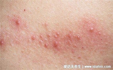 水泡和疱疹的区别图片,疱疹会有身体症状(带状疱疹神经痛)