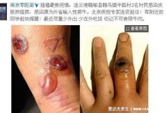 炭疽病图片人图片及症状,恶性脓疱在7天内