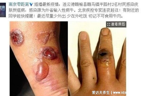 炭疽病图片人图片及症状，恶性脓疱在7天内坏死形成溃疡