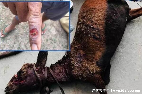 炭疽病图片人图片及症状，恶性脓疱在7天内坏死形成溃疡