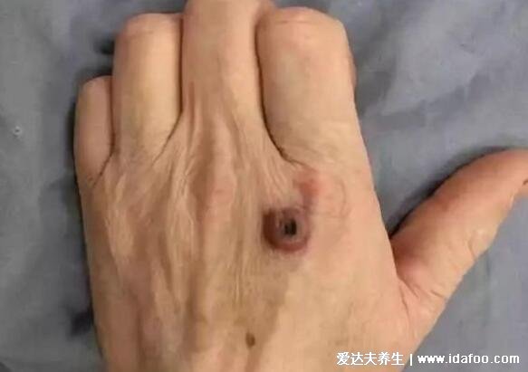 炭疽病图片人图片及症状，恶性脓疱在7天内坏死形成溃疡