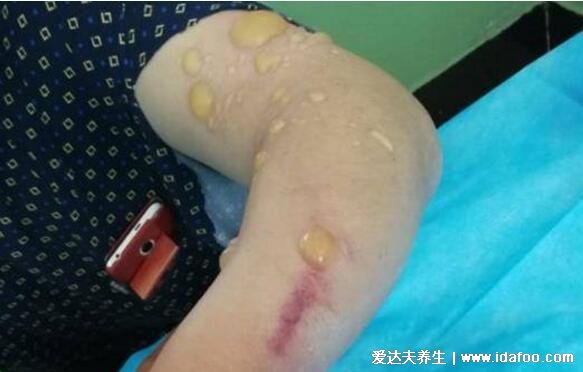 炭疽病图片人图片及症状，恶性脓疱在7天内坏死形成溃疡