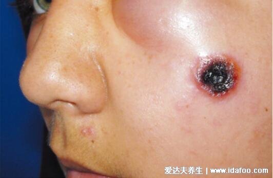 炭疽病图片人图片及症状，恶性脓疱在7天内坏死形成溃疡