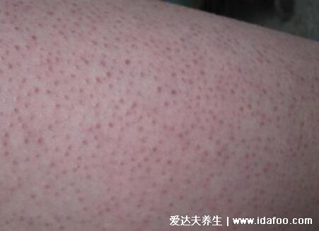 腿部和背上的毛囊炎图片,各个时期不同症状的图片