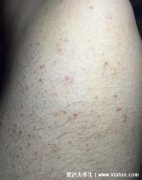 腿部和背上的毛囊炎图片，各个时期不同症