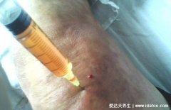 膝盖抽积液后悔死了，为什么不建议抽膝盖