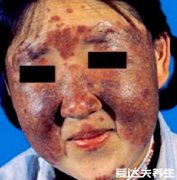 系统性红斑狼疮图片及死亡率,呈现蝴蝶状