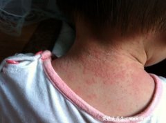 小儿痱子症状图片,热痱子明显很痒还脱屑