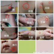 小孩口足手病轻微图片，有红色米粒大小的