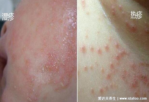 小儿痱子症状图片,热痱子明显很痒还脱屑(容易和湿疹弄混)