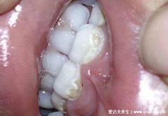 小朋友虫牙图片，虫牙里面真的有虫吗(没有