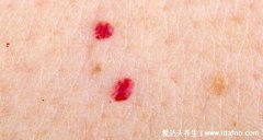 血管瘤最初小红点图片，最开始的症状不起