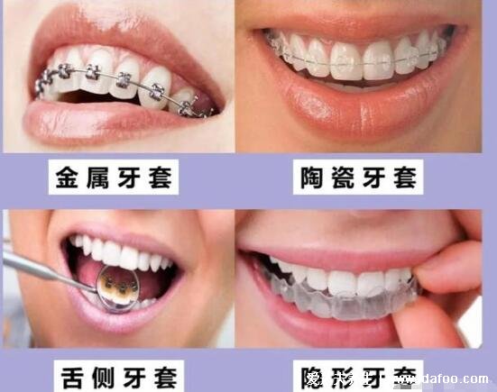 牙套价格一般是多少钱一个,钢丝牙套6千完全隐形牙套3万(看材质)