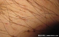 阴虱怎么彻底去除最简单的方法，4个步骤彻