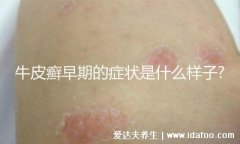 银癣图片初期症状，有鳞屑发亮薄膜还有出