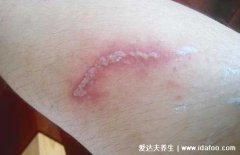 隐翅虫咬人后图片,隐翅虫图片咬后怎么处