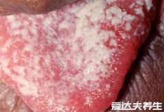 婴儿鹅口疮最早期图片，雪口病与奶渍相似