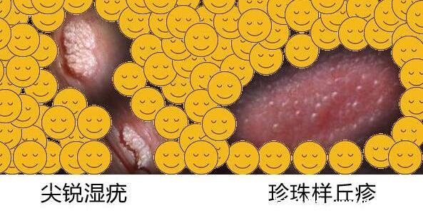 早期尖锐湿尤图症状女,女性假疣和真疣的区别图片
