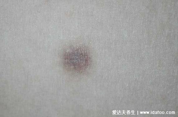 早期皮肤纤维瘤图片初期症状图,褐色圆形的硬疙瘩非常影响美观