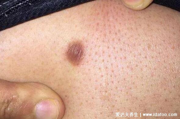 早期皮肤纤维瘤图片初期症状图,褐色圆形的硬疙瘩非常影响美观