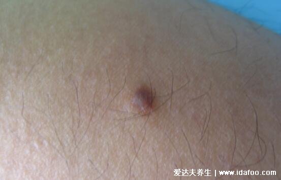 早期皮肤纤维瘤图片初期症状图,褐色圆形的硬疙瘩非常影响美观