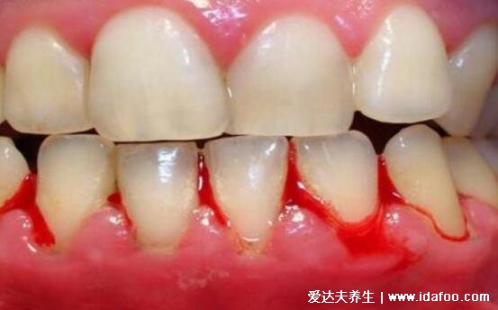 早期牙龈炎图片症状及治疗方法,牙龈出血的时候需警惕(5大症状)