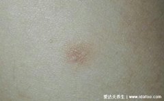 早期皮肤纤维瘤图片初期症状图,褐色圆形