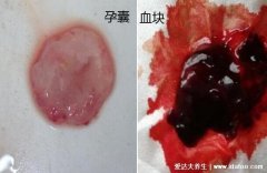 怎么分辨血块和孕囊图,血块和孕囊的区别