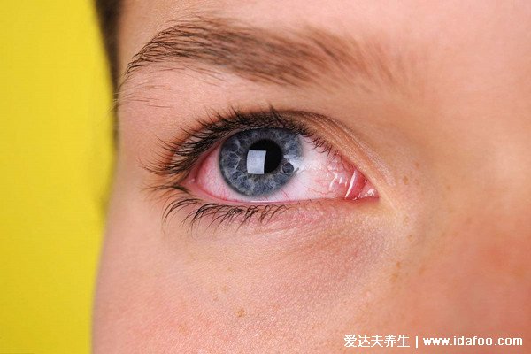 怎么判断是不是红眼病图片,眼睛红肿有分泌物(怕光还流泪)