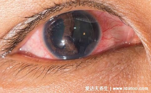 怎么判断是不是红眼病图片,眼睛红肿有分泌物(怕光还流泪)