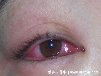 怎么判断是不是红眼病图片,眼睛红肿有分泌物(怕光还流泪)