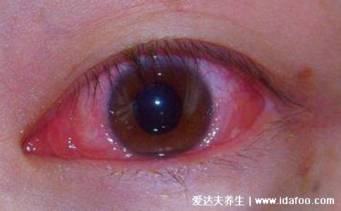 怎么判断是不是红眼病图片,眼睛红肿有分泌物(怕光还流泪)