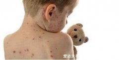 怎么判断是不是水痘图片,附7天演变过程
