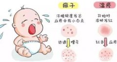 怎么确定是不是湿疹图片,湿疹和痱子的区