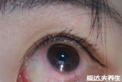长期戴隐形眼镜的危害，容易导致角膜炎等