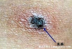 真实恙虫病图片症状,咬人后伤口会由皮疹