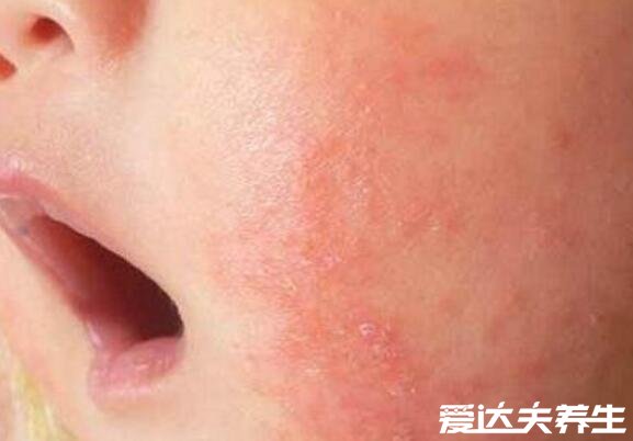 真实新生儿湿疹图片,小儿湿疹有三大类型注意区分