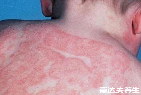真实新生儿湿疹图片,小儿湿疹有三大类型注意区分