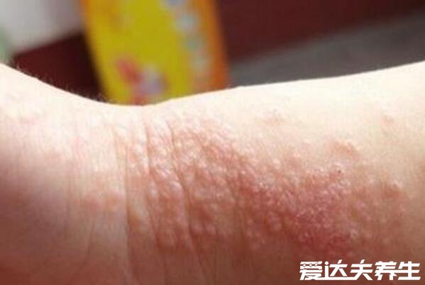 真实新生儿湿疹图片,小儿湿疹有三大类型注意区分