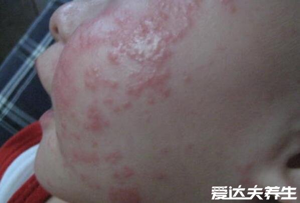 真实新生儿湿疹图片,小儿湿疹有三大类型注意区分