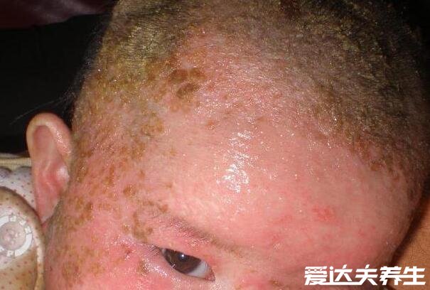 真实新生儿湿疹图片,小儿湿疹有三大类型注意区分