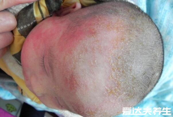 真实新生儿湿疹图片,小儿湿疹有三大类型注意区分