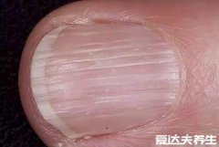 指甲有竖纹是身体的什么信号，处于亚健康