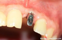 种植牙的利与弊，为什么良心医生不建议种