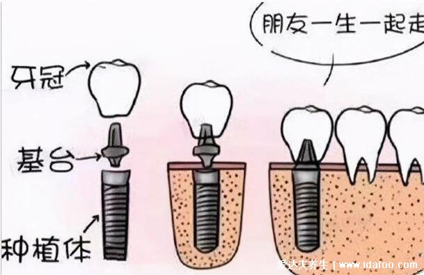 种植牙有什么风险和后遗症，为什么良心医生不建议种植牙